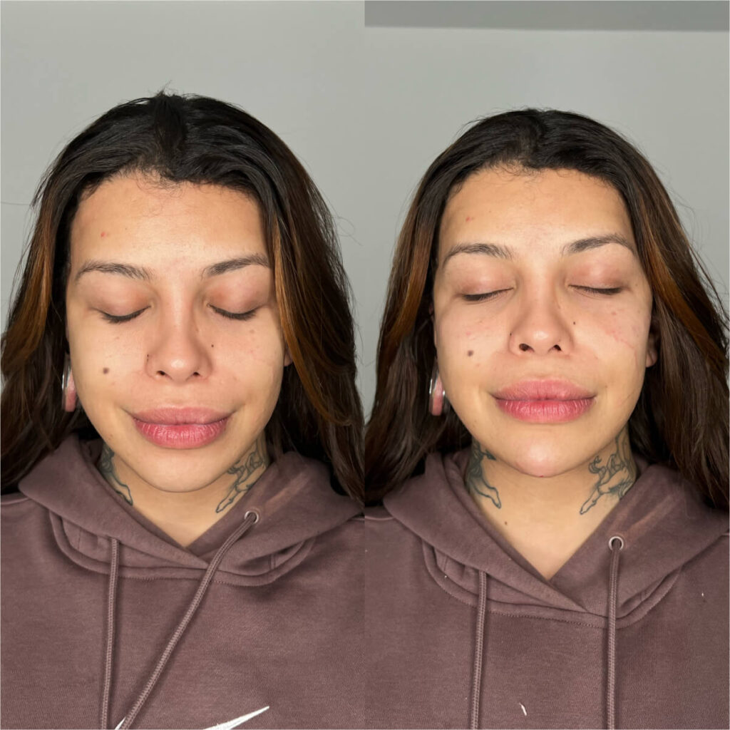 Chin Filler | Faces By Bae | London Aesthetics | Award Winning