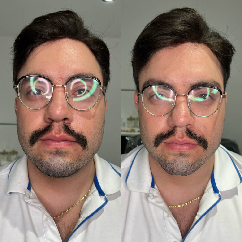 Chin Filler | Faces By Bae | London Aesthetics | Award Winning