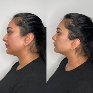 Understanding Laser Lipo: The Process & Aftercare