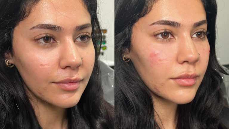 How to Know if Tear Trough Filler is Right for You?