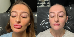 Ultrasound Guided Filler Dissolving