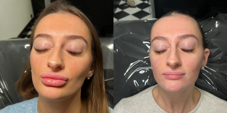 Ultrasound Guided Filler Dissolving