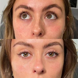 Polynucleotides vs Profhilo: Which Skin Rejuvenation Treatment Is Right for You?